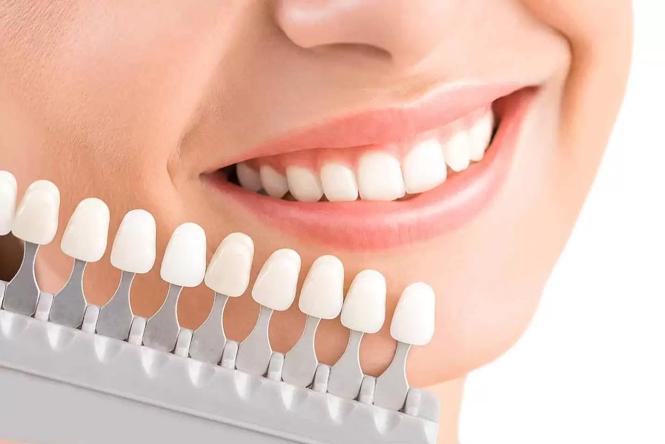 Diş Beyazlatma (Bleaching)