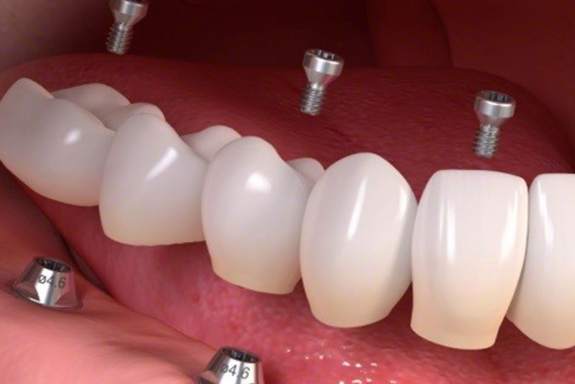 Diş implantı Nedir, Kimlere Uygulanır?